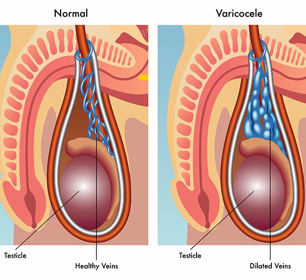 Artist-Illustration-of-the-Difference-Microscopic-Varicocelectomy-Can-Make