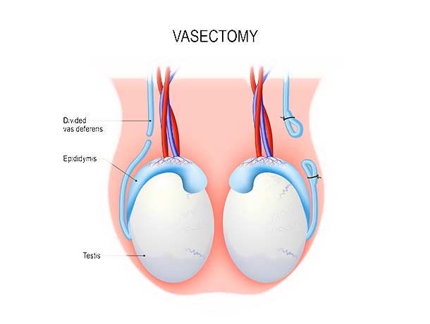 Artist-Illustration-of-the-Vasectomy-Procedure