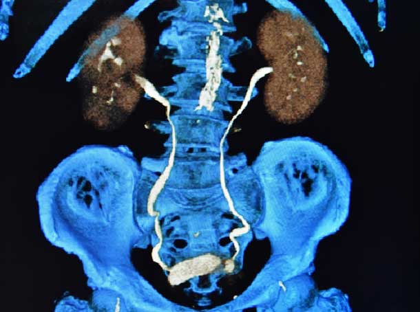 X-ray-of-the-Urinary-System