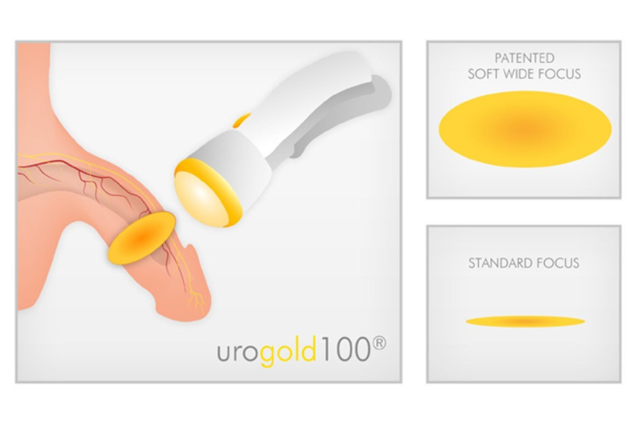 Urogold 100 Shockwave Therapy Uci Mens Health Male Infertility And Erectile Dysfunction 9526