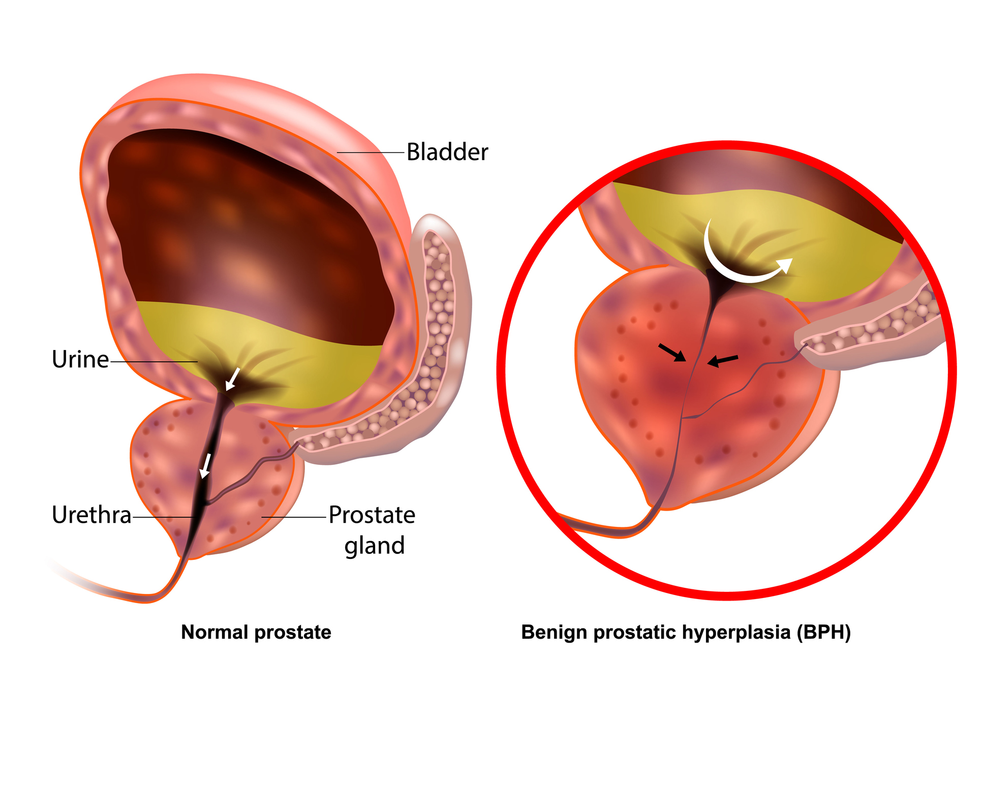 Medical illustration showing Benign prostatic hyperplasia BPH and Normal prostate. Prostate gland enlargement Medical illustration showing Benign prostatic hyperplasia BPH and Normal prostate. Prostate gland enlargement